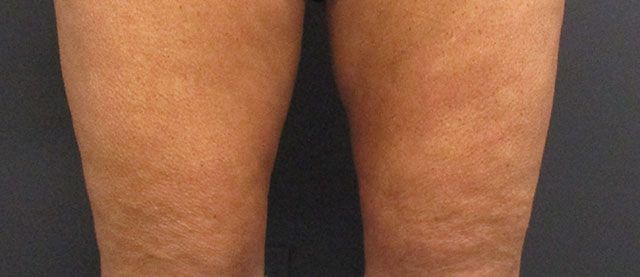 Morpheus8 Body Before & After