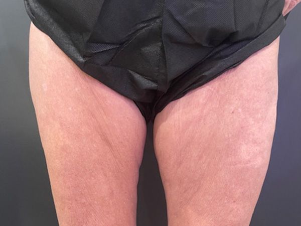 Morpheus8 Body Before & After