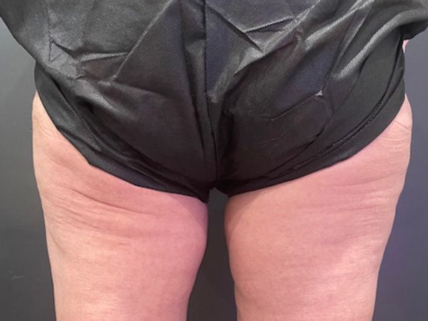 Morpheus8 Body Before & After