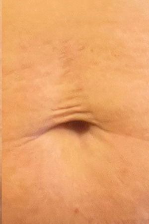 Morpheus8 Body Before & After