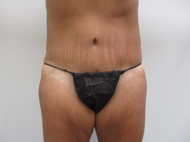 Liposuction Before & After