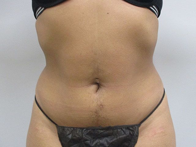Liposuction Before & After