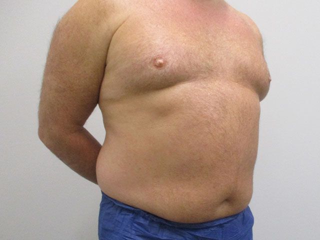 Liposuction Before & After