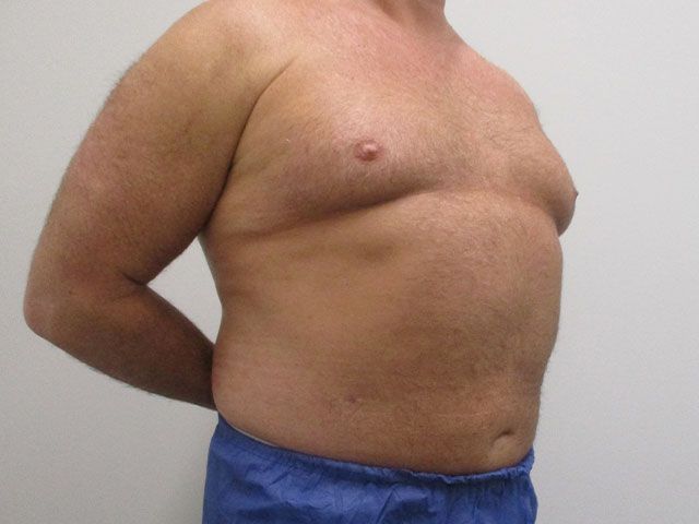 Liposuction Before & After