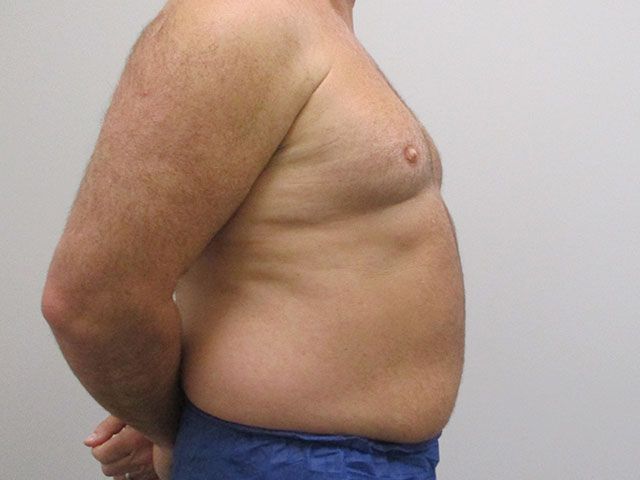 Liposuction Before & After