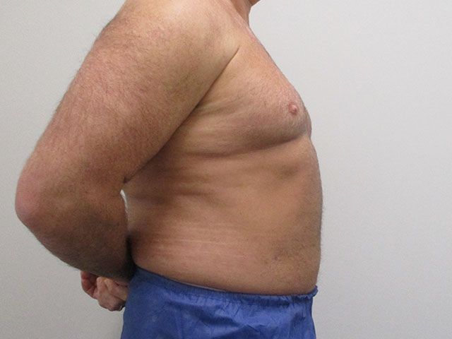 Liposuction Before & After