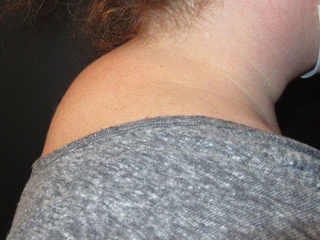 Liposuction Before & After