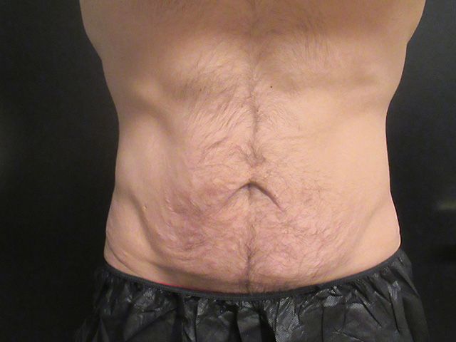 Body Contouring Package Before & After