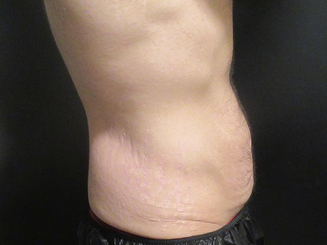 Body Contouring Package Before & After