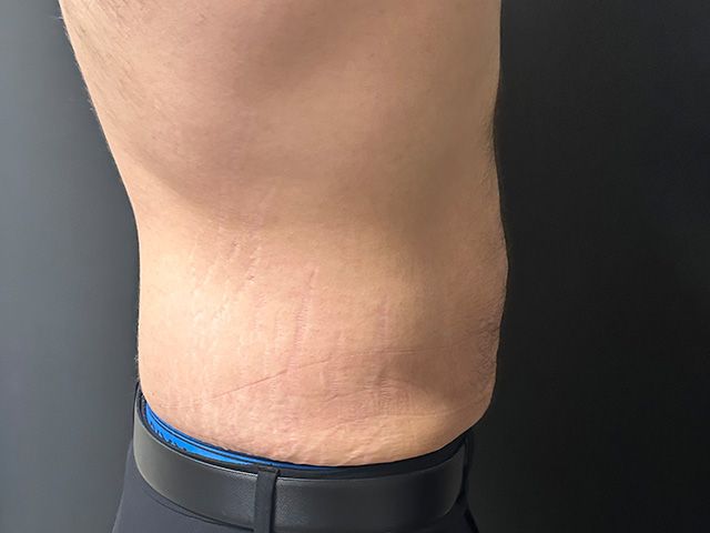 Body Contouring Package Before & After