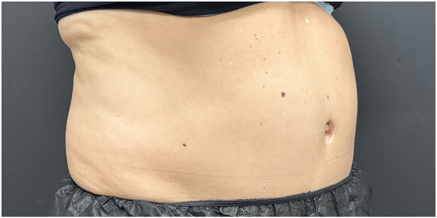 Body Contouring Package Before & After