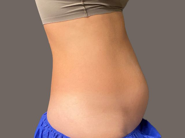 Body Contouring Package Before & After