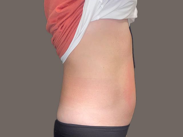 Body Contouring Package Before & After