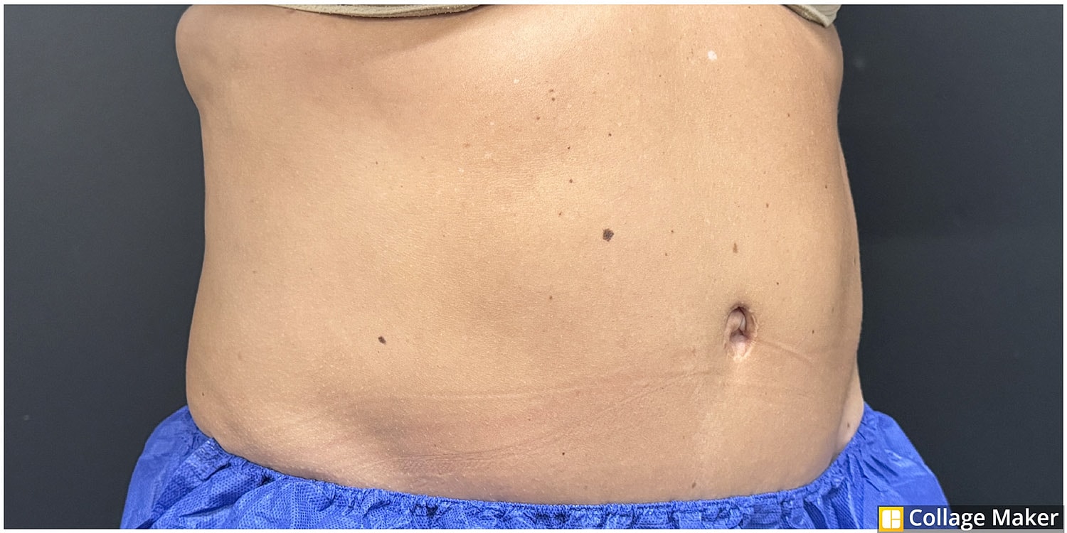 Body Contouring Package Before & After