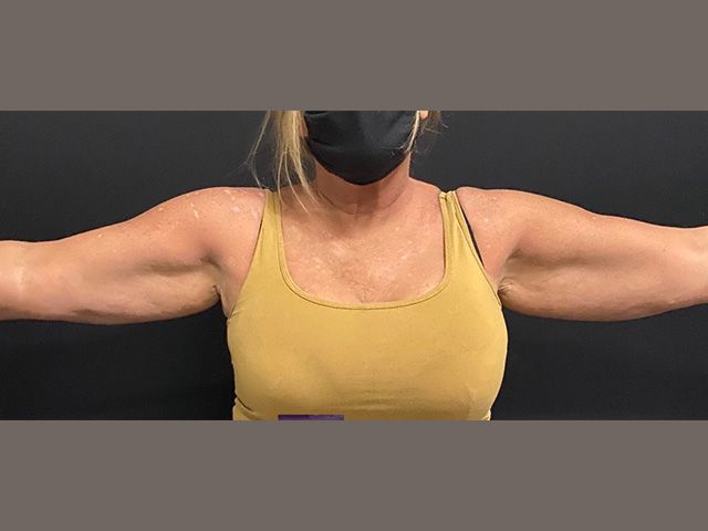 Body Contouring Package Before & After