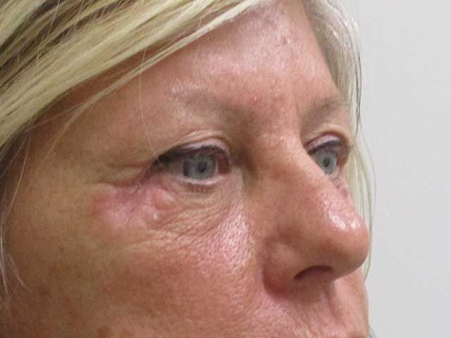 Blepharoplasty Before & After
