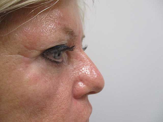 Blepharoplasty Before & After