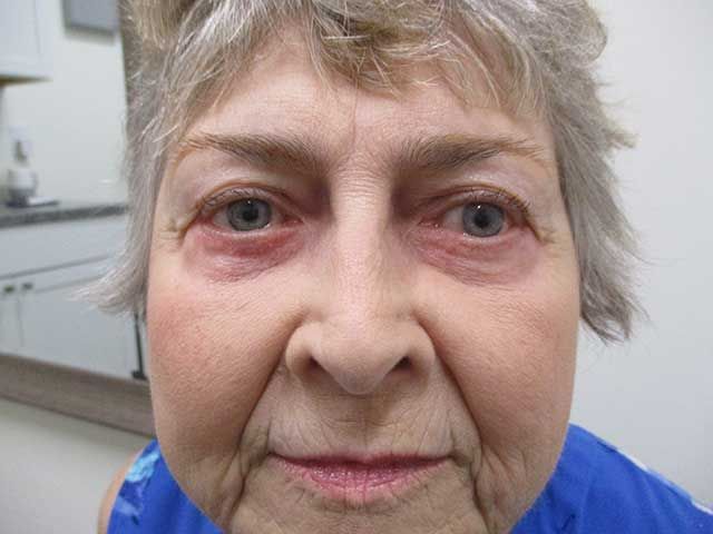 Blepharoplasty Before & After