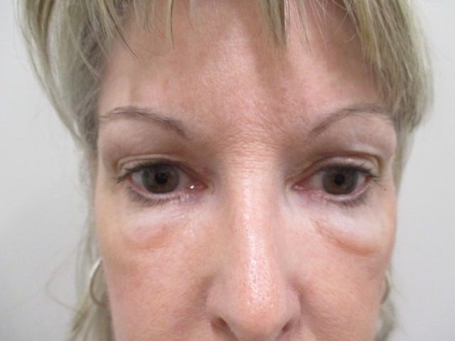 Blepharoplasty Before & After