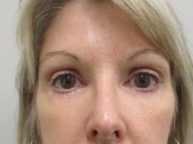Blepharoplasty Before & After
