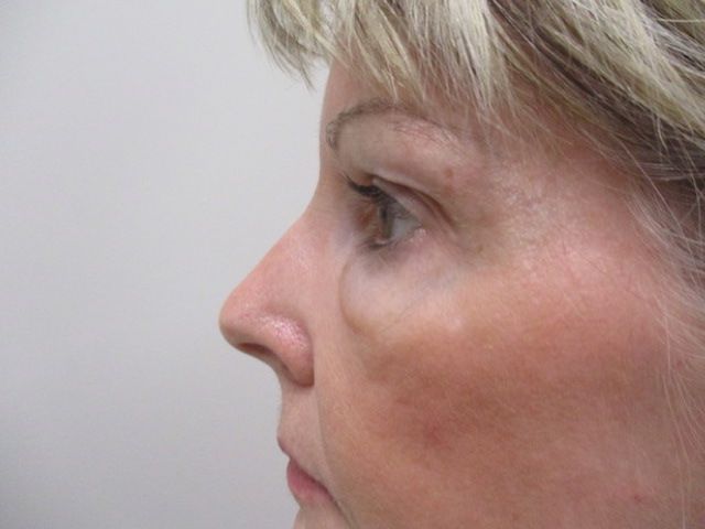 Blepharoplasty Before & After