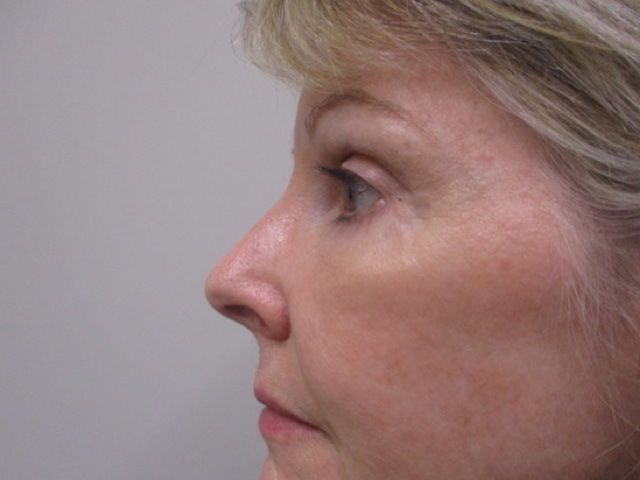 Blepharoplasty Before & After