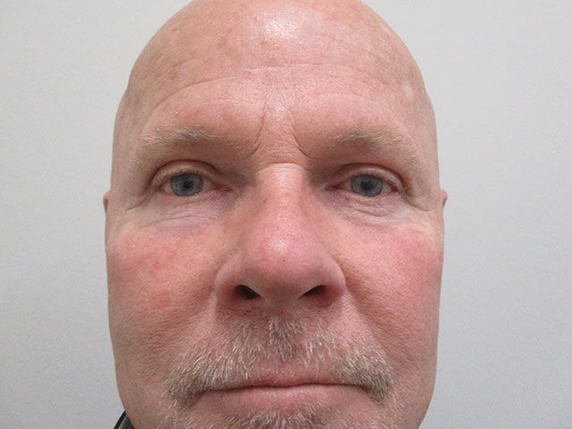 Blepharoplasty Before & After