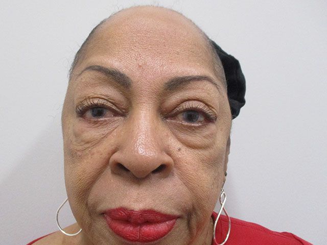 Blepharoplasty Before & After