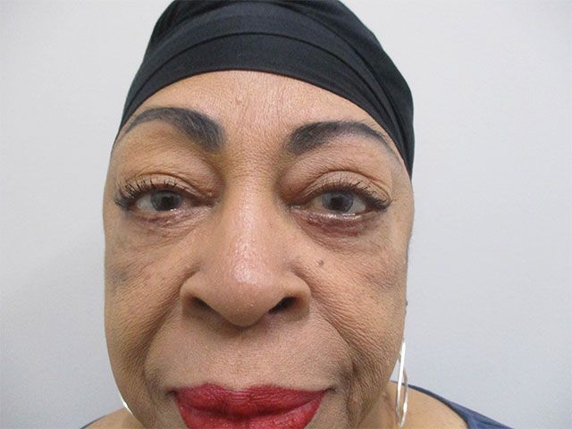 Blepharoplasty Before & After