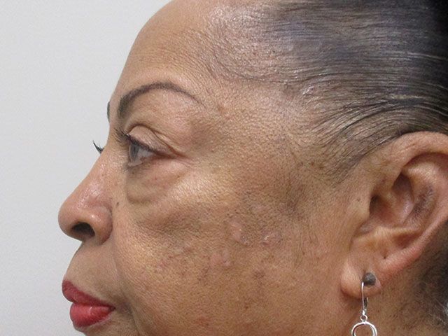 Blepharoplasty Before & After