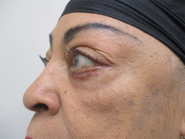 Blepharoplasty Before & After