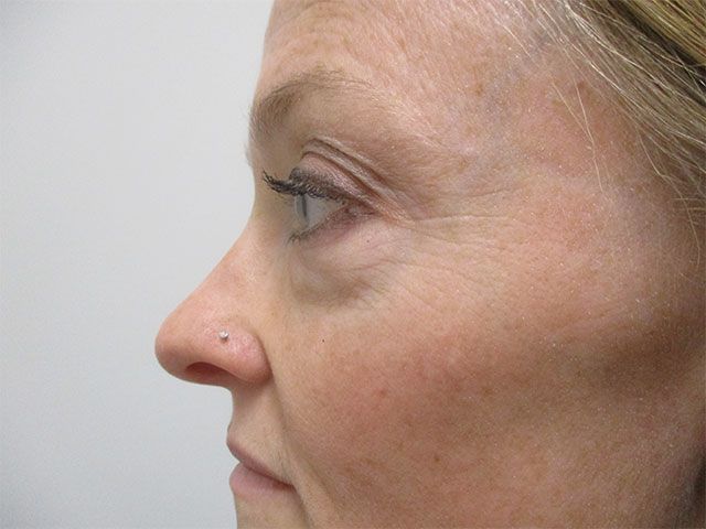 Blepharoplasty Before & After