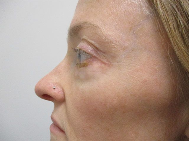 Blepharoplasty Before & After
