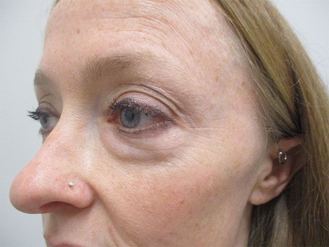 Blepharoplasty Before & After