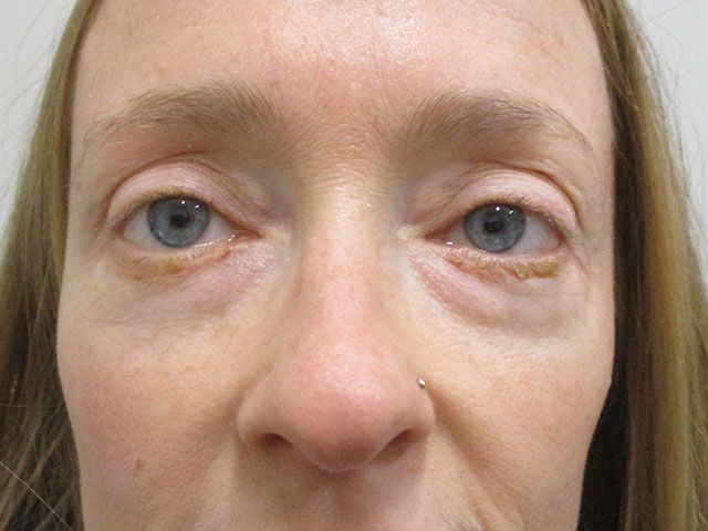 Blepharoplasty Before & After
