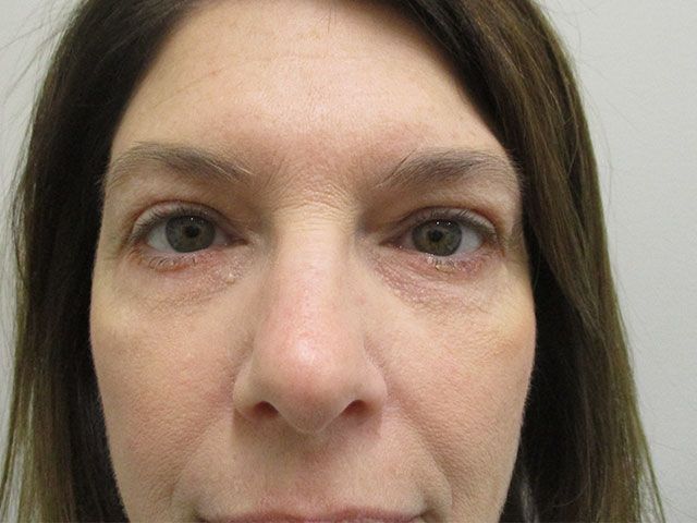 Blepharoplasty Before & After