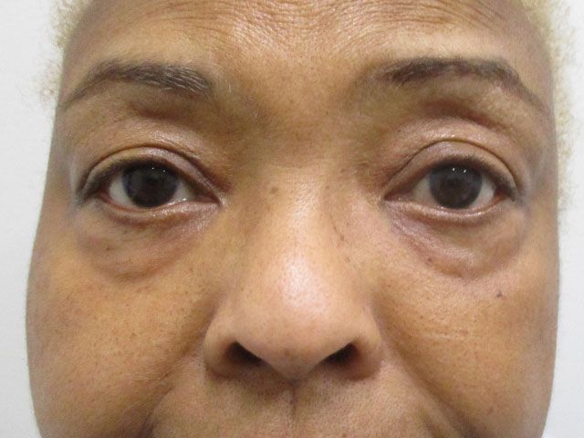 Blepharoplasty Before & After