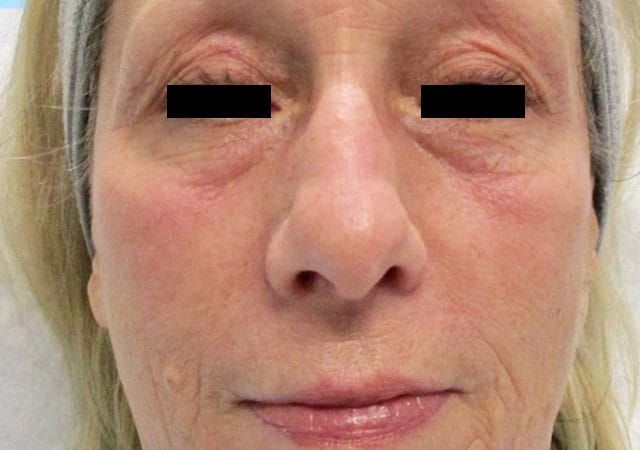 Blepharoplasty Before & After