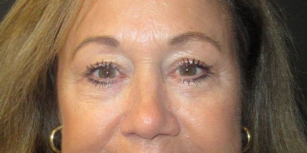 Blepharoplasty Before & After