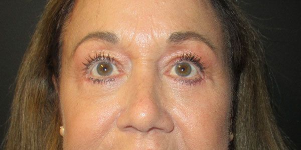 Blepharoplasty Before & After