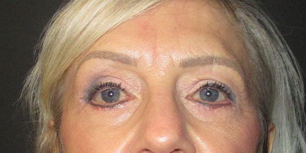 Blepharoplasty Before & After