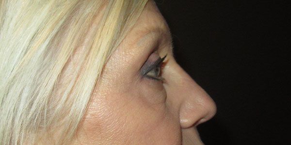 Blepharoplasty Before & After