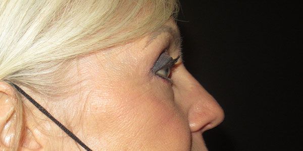 Blepharoplasty Before & After