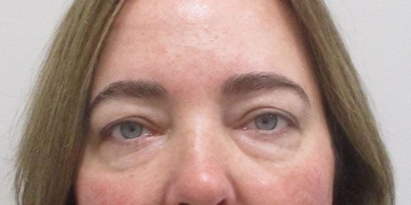 Blepharoplasty Before & After