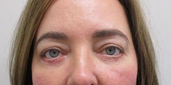 Blepharoplasty Before & After