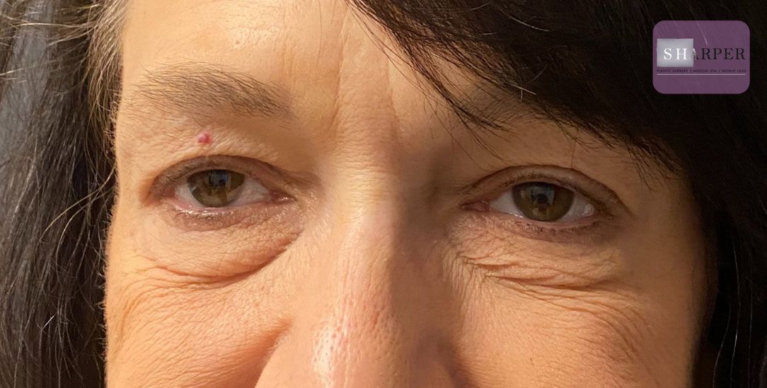 Blepharoplasty Before & After