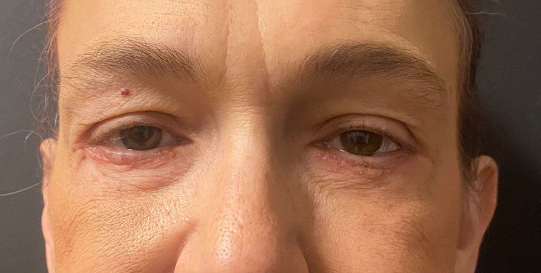 Blepharoplasty Before & After