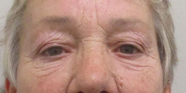 Blepharoplasty Before & After
