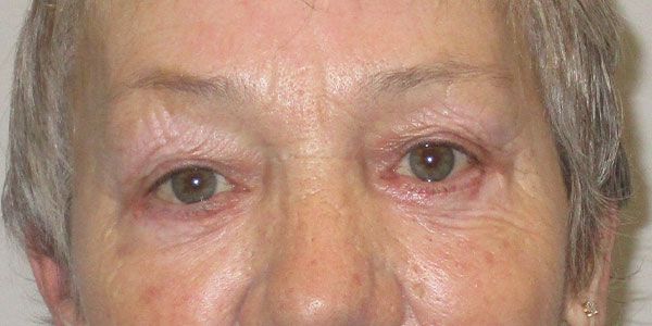 Blepharoplasty Before & After
