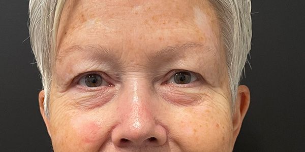 Blepharoplasty Before & After